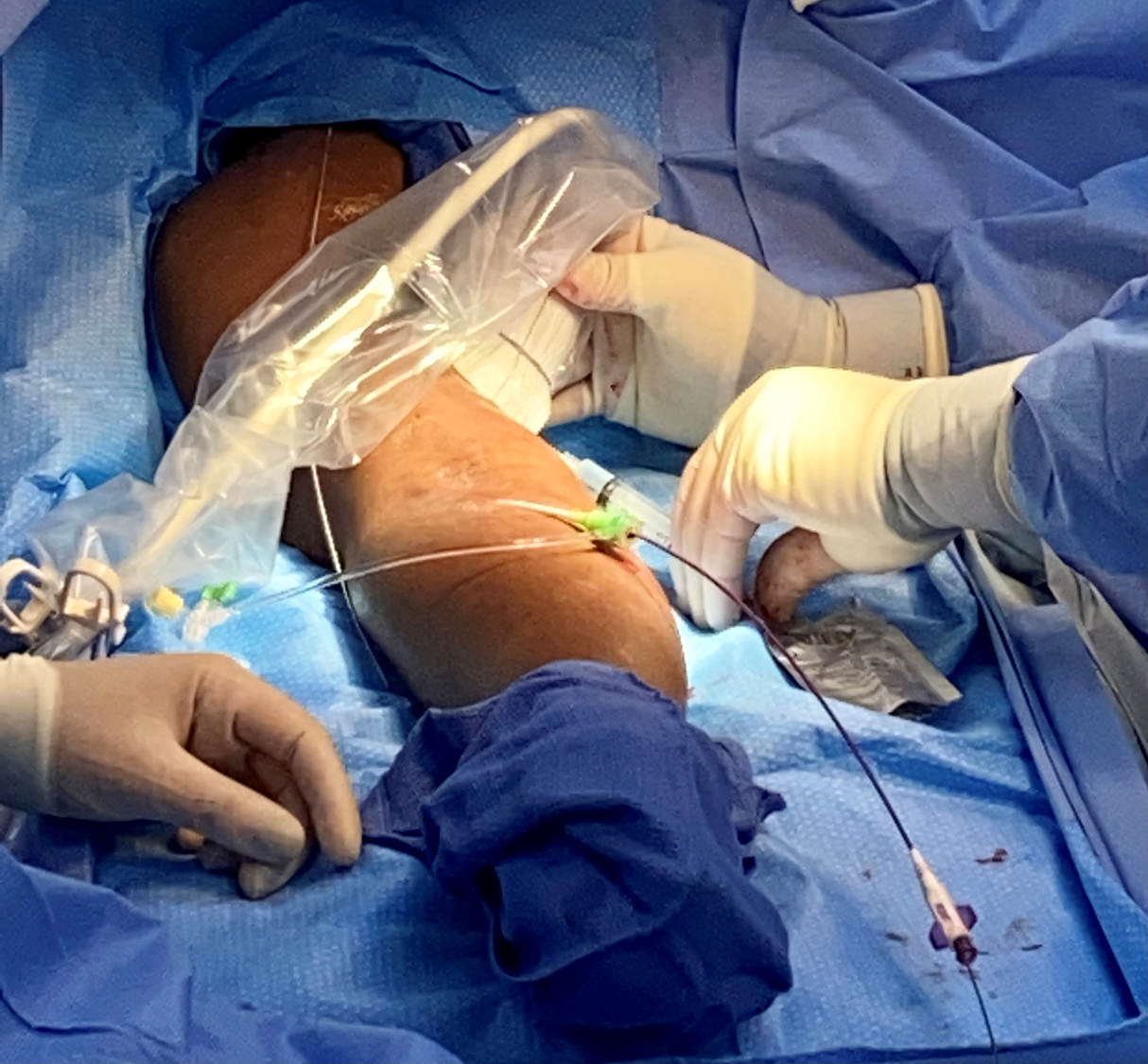 Interventional nephrology vascular access procedure